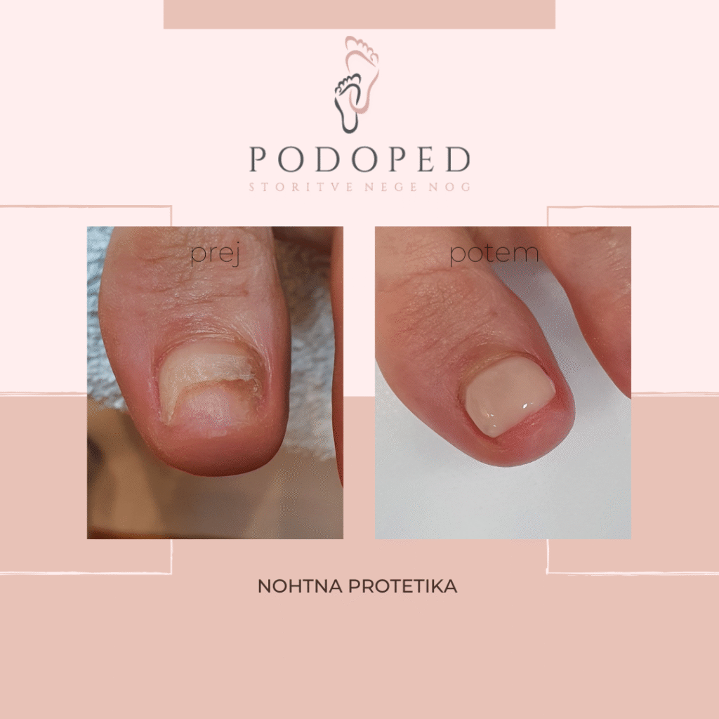 PODOPED_nohtna_protetika