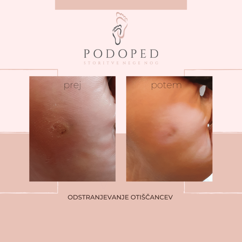 PODOPED_odstranjevanje_otiščancev