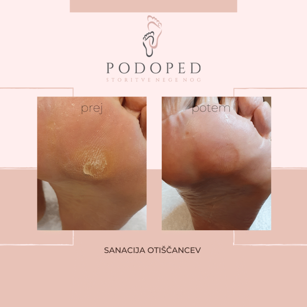 PODOPED_odstranjevanje_otiščancev_II