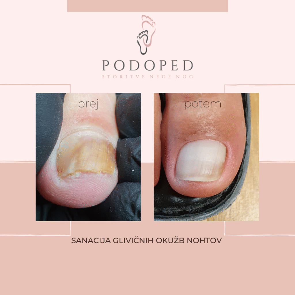 PODOPED_sanacija_glivičnih_okužb_nohtov