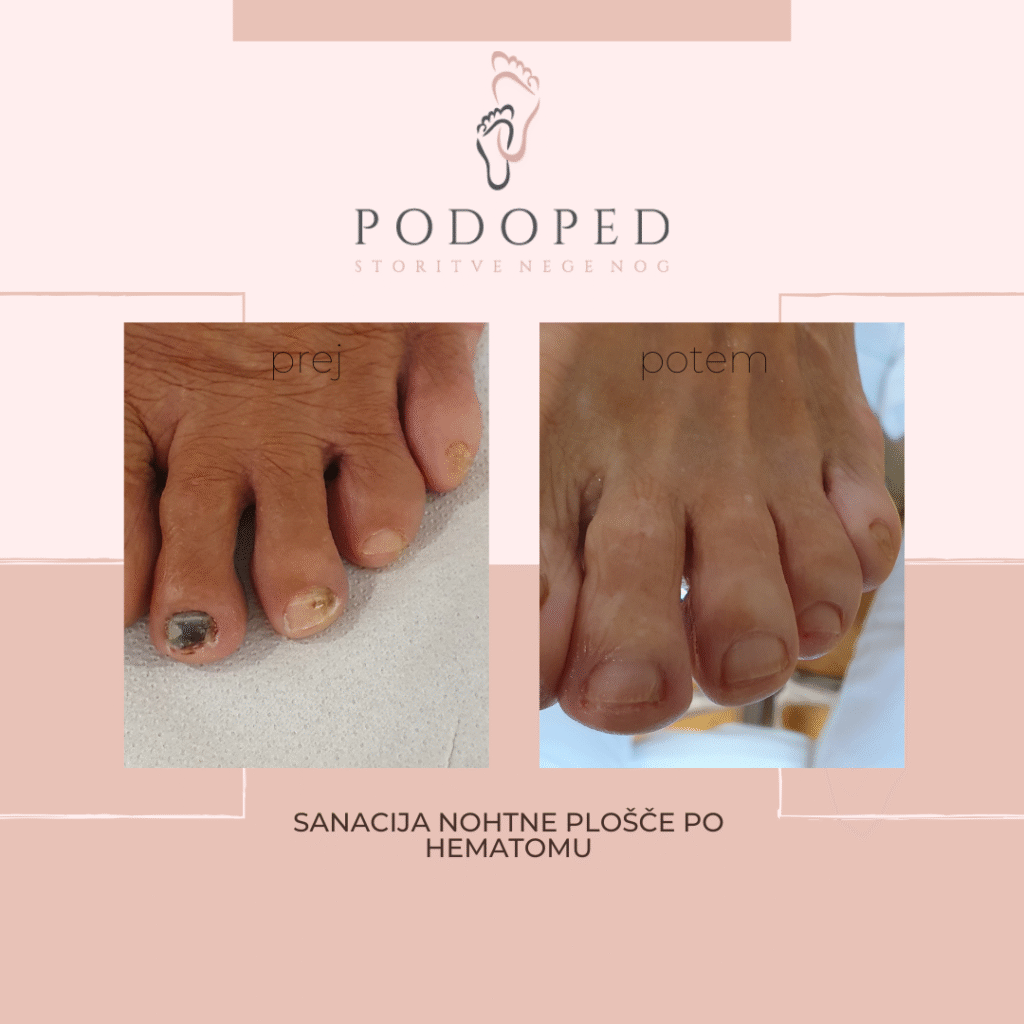 PODOPED_sanacija_hematoma_pod_nohtom