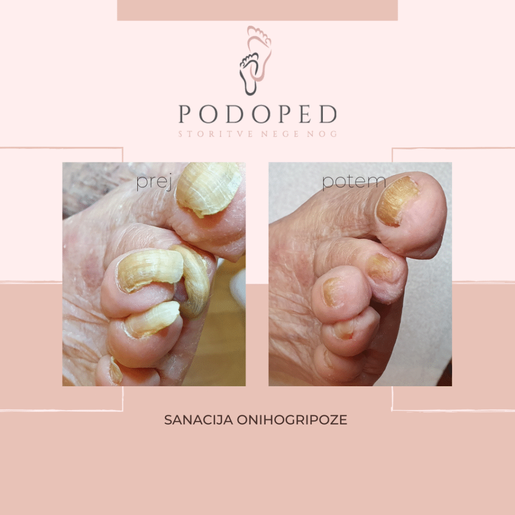 PODOPED_sanacija_onihogripoze