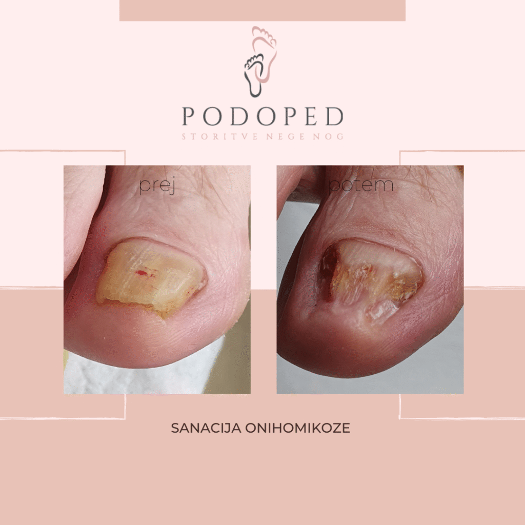 PODOPED_sanacija_onihomikoze