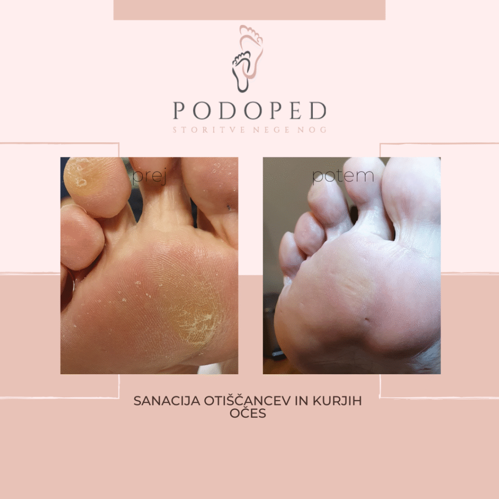 PODOPED_sanacija_otiščancev_in_kurjih_očes