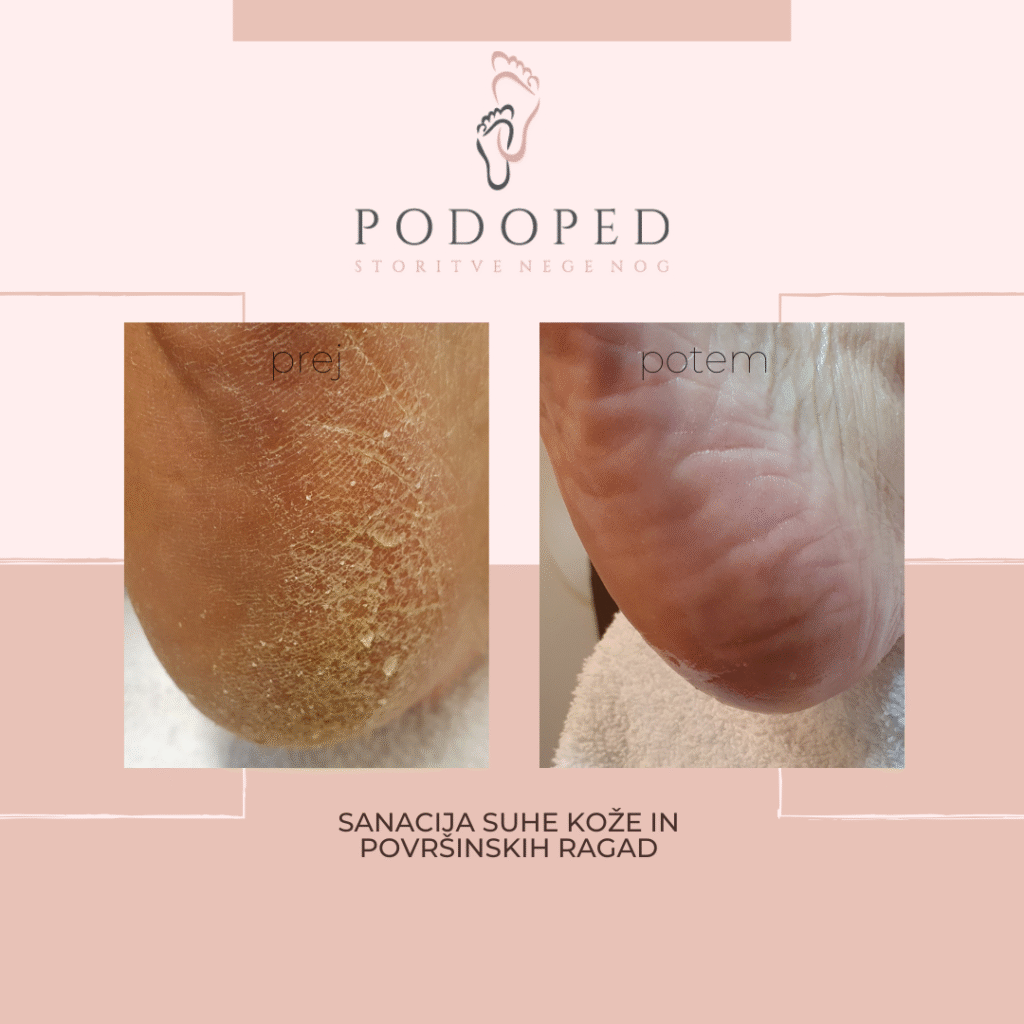 PODOPED_sanacija_suhe_kože_in_površinskih_ragad