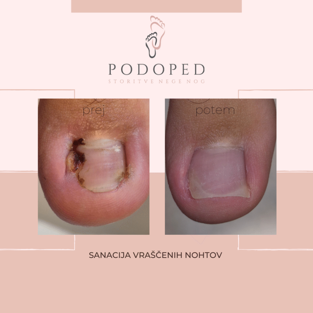 PODOPED_sanacija_vraščenih_nohtov