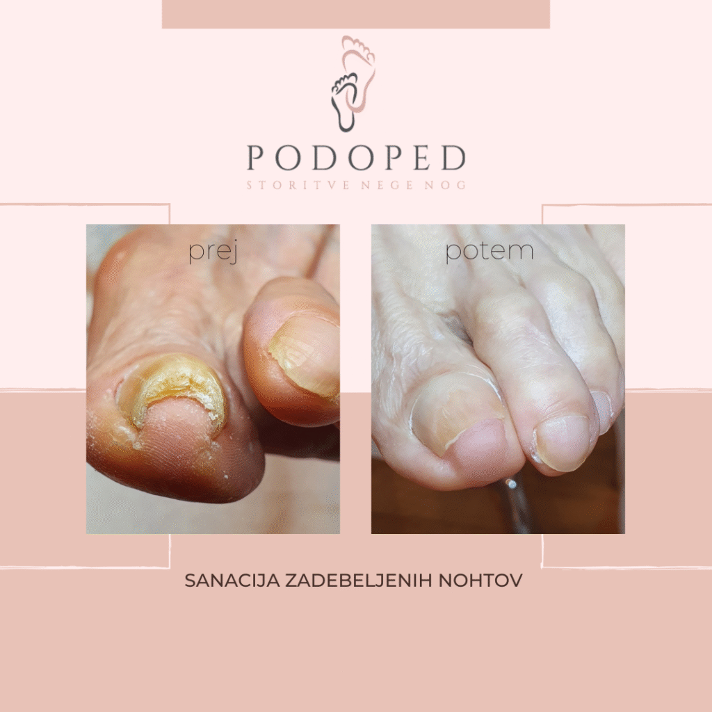 PODOPED_sanacija_zadebeljenih_nohtov
